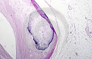 Artery calcification histopathology photo