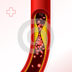 Artery with cholesterol buildup - cholesterol and thromb