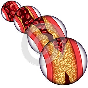 Artery Disease Diagram photo