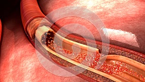 Artery Dissection