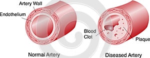 Artery with Plaque and Blood Clot