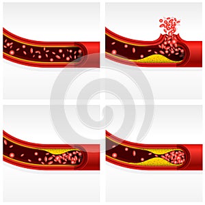 Artery section with cholesterol and thrombosis, cerebral stroke