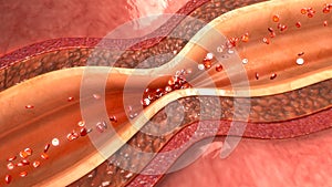 Artery Spasm