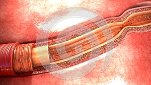 Artery Spasm photo