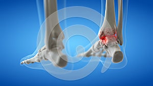 An arthritic ankle joint