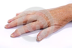 Arthritic Hand photo