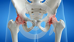 An arthritic hip joint