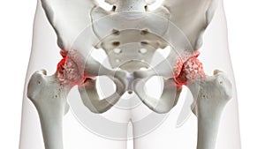 An arthritic hip joint photo