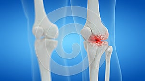 An arthritic human knee joint photo