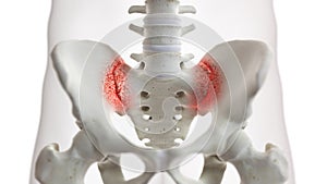 An arthritic iliosacral joint