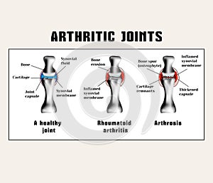 Arthritic joins (rheumatoid arthritis, arthrosis (osteoarthritis)).