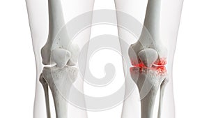 An arthritic knee joint