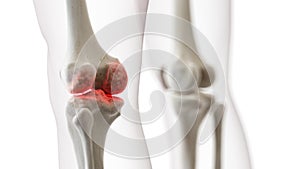 an arthritic knee joint