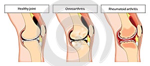 Arthritic knee joint photo