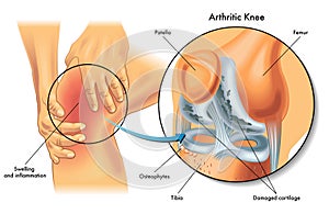 Arthritic knee photo