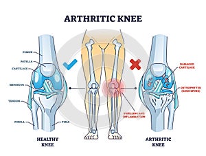 Arthritic knee or osteoarthritis and healthy bones comparison outline diagram