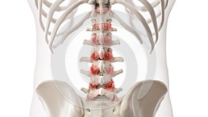 An arthritic lumbar spine