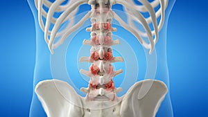 An arthritic lumbar spine
