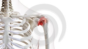 An arthritic shoulder joint