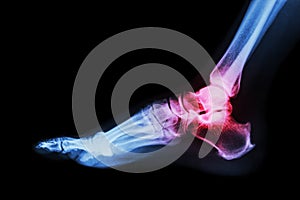 Artritis sobre el tobillo articulación ( reumatoide artritis) 
