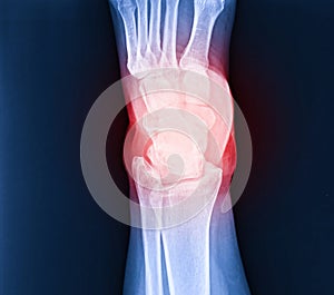 Arthritis at ankle joint (Gout , Rheumatoid arthritis photo