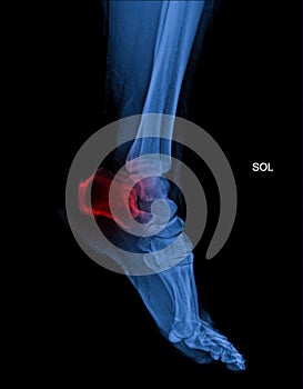 Arthritis at ankle joint (Gout , Rheumatoid arthritis photo