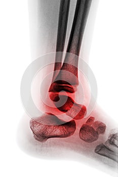 Arthritis of ankle & x28; Juvenile rheumatoid & x29;