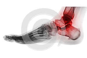 Arthritis of ankle . X-ray of foot . Lateral view . Invert color style