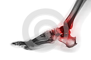 Arthritis of ankle . X-ray of foot . Lateral view . Invert color style . Gout or Rheumatoid concept