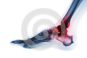 Arthritis of ankle . X-ray of foot . Lateral view . Invert color style . Gout or Rheumatoid concept photo