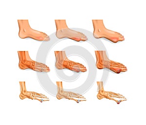 Arthritis, arthrosis of the big toe