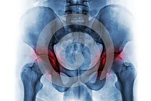 Arthritis both hip . Film x-ray of human pelvis .