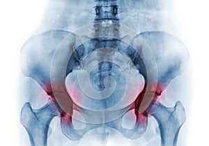 Arthritis both hip . Film x-ray of human pelvis