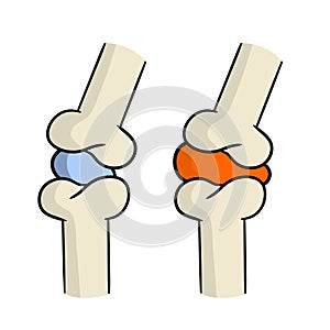 Arthritis. Disease of joints. Bones and interosseous cartilage