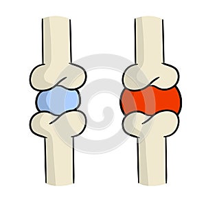 Arthritis. Disease of joints. Bones and interosseous cartilage