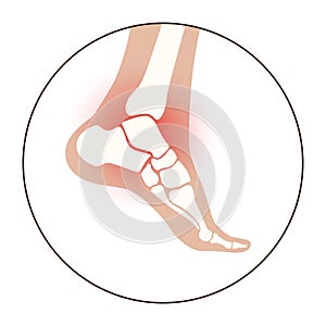 Arthritis foot concept