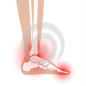 Arthritis foot concept