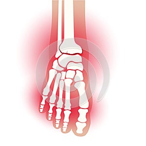 Arthritis foot concept