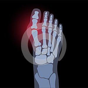 Arthritis foot concept