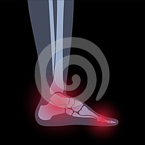 Arthritis foot concept