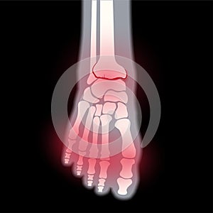 Arthritis foot concept