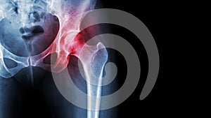 Arthritis at hip joint . Film x-ray show inflamed of hip joint and blank area at right side . Avascular necrosis concept