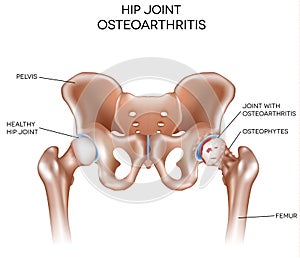 Artritis de cadera articulación 