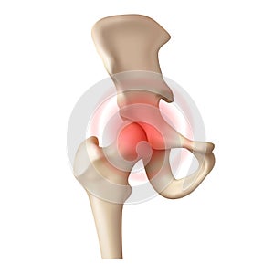 Arthritis of the hip joint on a white background