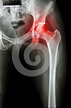 Arthritis at hip joint