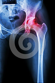 Arthritis at hip joint