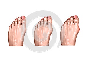 Arthritis injuries of the foot