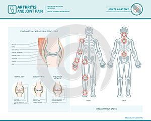 Arthritis and joint pain infographic