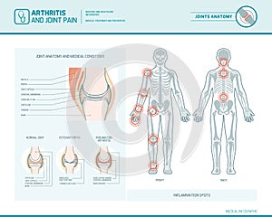 Arthritis and joint pain infographic photo