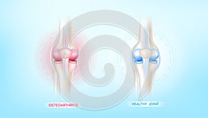 Arthritis knee joint in leg and bone healthy. Human bone anatomy damage treatment osteoarthritis. Skeleton x ray scan concept.